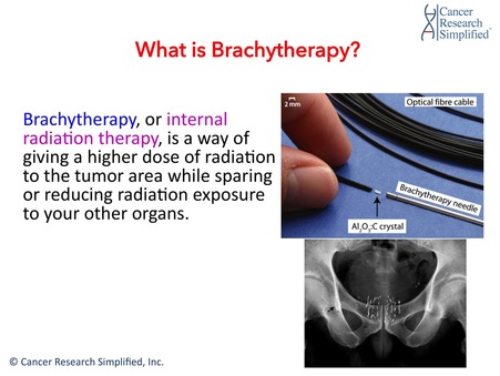 What is Brachytherapy - Cancer Research Simplified 
