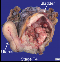 Urothelial carcinoma 