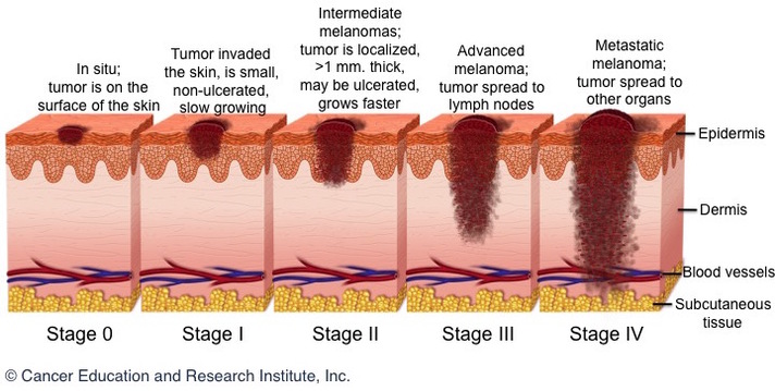 Melanoma stages - Cancer Education and Research Institute (CERI)
