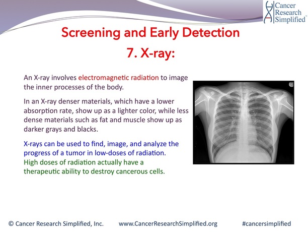 X-ray - Cancer Research Simplified
