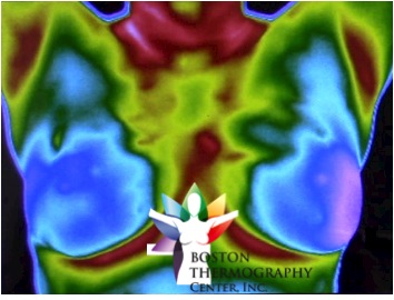 Learn all about Thermography and Cancer Screening - Cancer Research Simplified - Boston Thermography