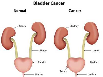 What is Bladder Cancer?  Cancer Education and Research Institute (CERI)