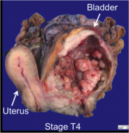 Bladder cancer - stage 4 - Cancer Education and Research Institute (CERI) 