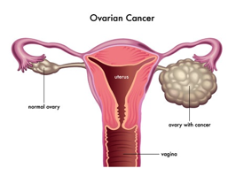 Rubraca (rucaparib) - ovarian cancer - Cancer Education and Research Institute (CERI)(