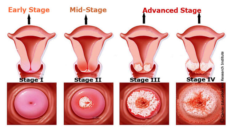 Cervical cancer stages | Cancer Education and Research Institute (CERI)