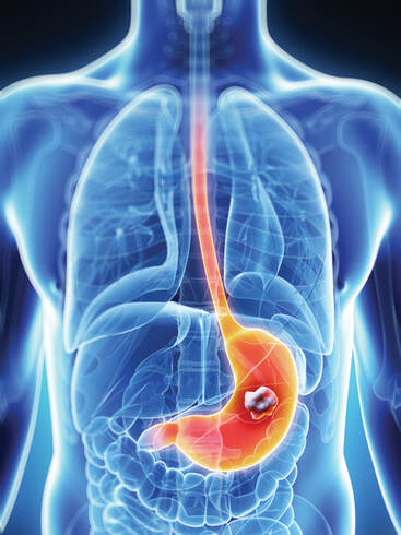 What is gastric cancer? What is stomach cancer? | Cancer Education and Research Institute (CERI)
