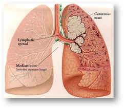 Non-small cell lung cancer - Cancer Education and Research Institute (CERI)