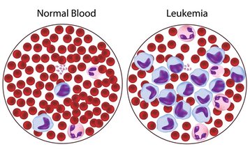 Leukemia - Venclexta (venetoclax) - Cancer Education and Research Institute (CERI)