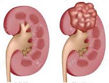 Renal cell cancer - Opdivo (nivolumab) - Cancer Education and Research Institute (CERI)